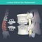 Lumbar Artificial Disc Replacement. Human bone anatomy.