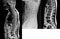 Lumbar spine lateral views x-ray and mri scan showing compression fracture of L2