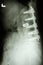 Lumbar spine with pedicle fixation