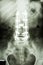 Lumbar spine with pedicle fixation