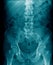 Lumbar spine x-ray image