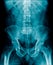 Lumbar spine x-ray image