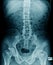 lumbar spine x-ray image