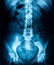 Lumbar Spine X-ray, Lower Back