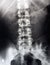 Lumbar spine x-ray, lower back