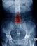Lumbar spondylosis x-ray image