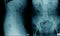 lumbar spondylosis x-ray image