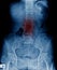 Lumbar spur and scoliosis and spondylosis