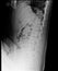 Lumbosacral spine x-ray. Lateral view.