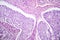 Lung adenocarcinoma, light micrograph