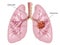 Lung cancer