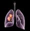 Lung cancer or bronchial carcinoma, 3D medically illustration on black background