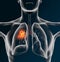 Lung cancer or bronchial carcinoma of a man, 3D medically illustration on black background