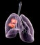 Lung cancer or broncial carcinoma, medical 3D illustration on black background