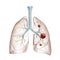 Lung cancer or carcinoma 3D rendering illustration. Bronchial tree and lungs infected by cancer cells on white background. Medical