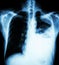 Lung cancer ( film x-ray of chest PA upright : show pleural effusion at left lung due to lung cancer ) ( 2 type of lung cancer :