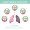 Lung cancer symptoms and signs. Respiratory disease.