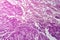 Lung cancer tissue, light micrograph