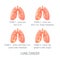 Lung cancer vector concept in flat style