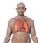 Lung histoplasmosis, a fungal infection caused by Histoplasma capsulatum, 3D illustration