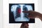 Lung radiography concept. Radiology doctor examining at chest x ray film of patient Lung Cancer or Pneumonia. Virus and