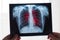 Lung radiography concept. Radiology doctor examining at chest x ray film of patient Lung Cancer or Pneumonia. Virus and