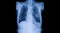 lung xray smoking pictures