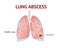 Lungs abscess, lungs disease, isolated vector illustration on White background