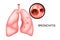 The lungs, affected with bronchitis