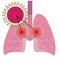 Lungs affected with coronavirus infection COVID19