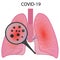 Lungs affected with coronavirus infection COVID19