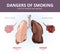 Lungs and alveoli of a healthy person smoker