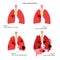 Lungs cancer disease