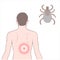 Lyme disease, Borreliosis or Borrelia