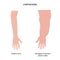Lymphedema of arm