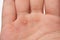 Macro of blister on human hand