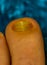 Macro close up of a fungus infected toe nail, common infections and diseases