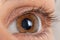 Macro eye photo. Keratoconus 2 degree - eye disease, thinning of the cornea in the form of a cone. The cornea plastic