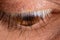 Macro eye photo. Keratoconus 3 degree - eye disease, thinning of the cornea in the form of a cone. The cornea plastic