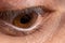 Macro eye photo. Keratoconus 4 degree - eye disease, thinning of the cornea in the form of a cone. The cornea plastic