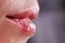 Macro photography of female lips suffering from herpes
