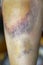 Macro shot of bruise on skin