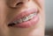 Macro shot of white teeth with braces. Female patient with metal brackets at the dental office