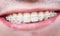 Macro shot of white teeth with braces. Smiling male patient with metal brackets