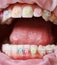 Macro snapshot of teeth and ceramic braces with colorful rubber bands on them, latex cheek retractor on lips