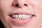 Macro snapshot of white teeth and ceramic braces with colorful rubber bands on them, beautiful smile