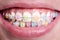 Macro snapshot of white teeth and ceramic braces with colorful rubber bands on them, beautiful smile