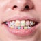 Macro snapshot of white teeth and ceramic braces with colorful rubber bands on them, beautiful smile