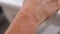 MACRO: Unrecognizable Caucasian person\'s hand is full of swollen mosquito bites.