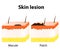 Macule and Patch. Types of skin lesions